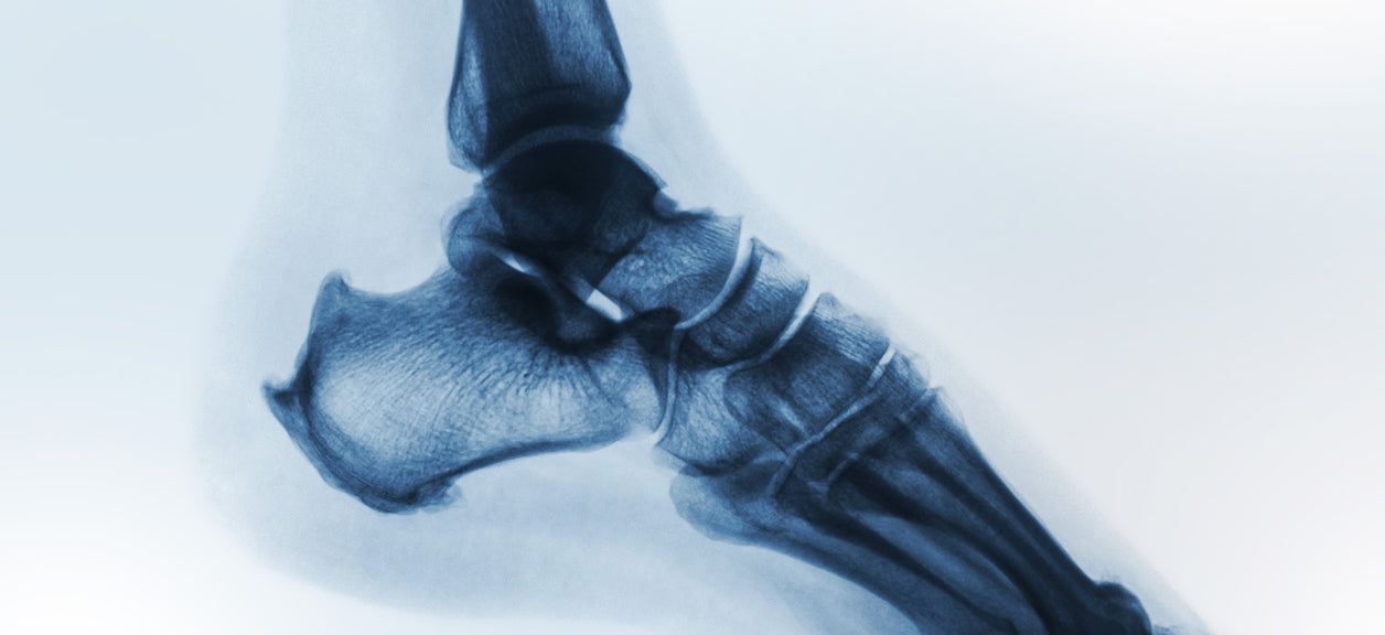 x-ray of foot