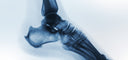 x-ray of foot